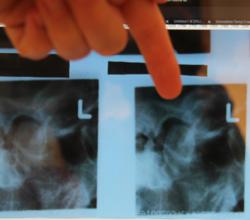 Temporomandibular joint X Ray shown by Dr Korwin, Middletown New Jersey